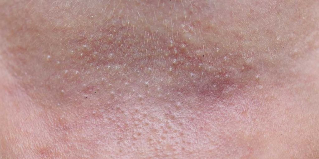 Dermatite da sudore. sudore freddo - Traducere în română - exemple în italiană | Reverso Context